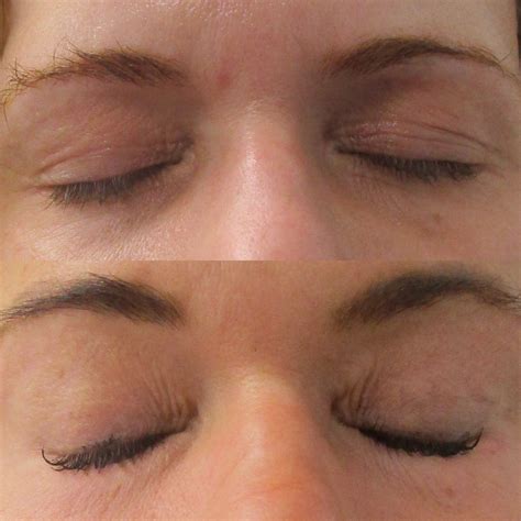 CO2 Laser Before and After Photos • Dr. Cameron Rokhsar