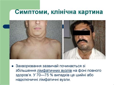 Злоякісні лімфоми - презентация онлайн