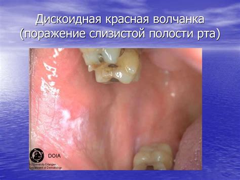 Коллагенозы: красная волчанка, склеродермия - презентация онлайн