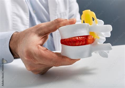 Anatomical lumbar disc herniation model in doctor hand while ...