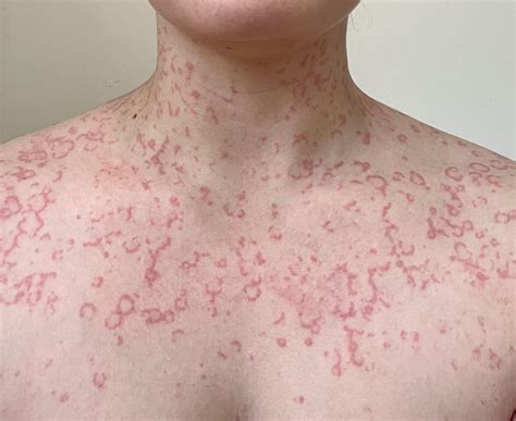 anyone else seen stress hives like this : r/urticaria