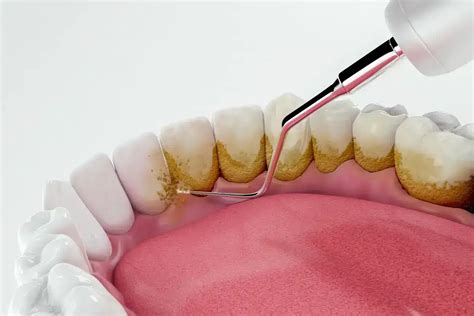 Plak na zubima | Dentus perfectus ordinacija - Prevencija protiv ...