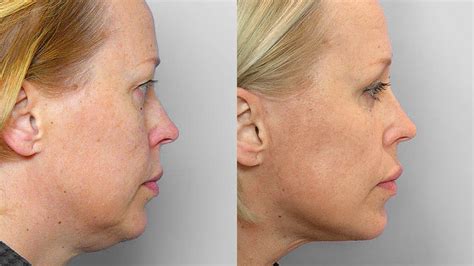 Before & after pictures of IPL laser treatment | Conturkliniken®.