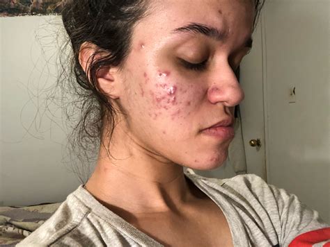 MY ACNE IS GETTING WORSE – Acne – Acne.org Forum