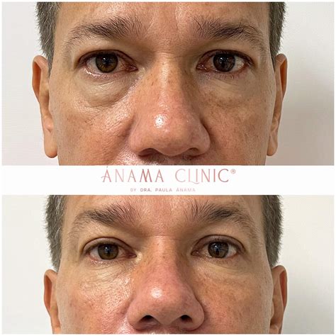 tratamiento de ojeras anama clinic