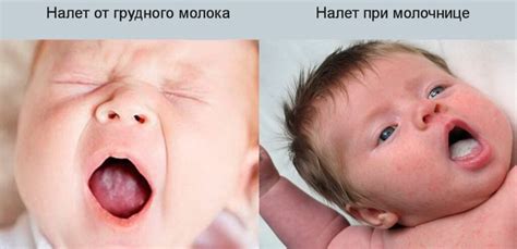 Белые точки во рту у грудничка или узелки Бона