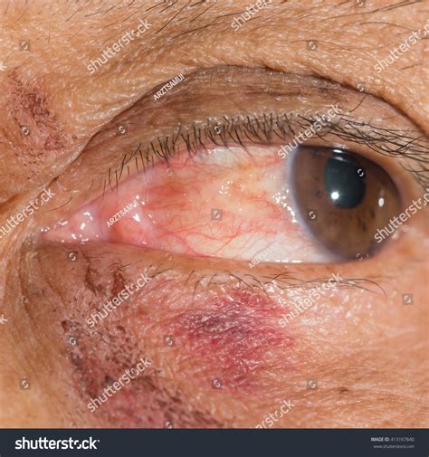 Close Episcleritis During Eye Examination Foto de stock 413167840 ...