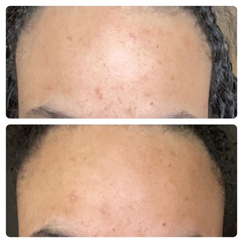 Azelaic Acid With Tretinoin 2