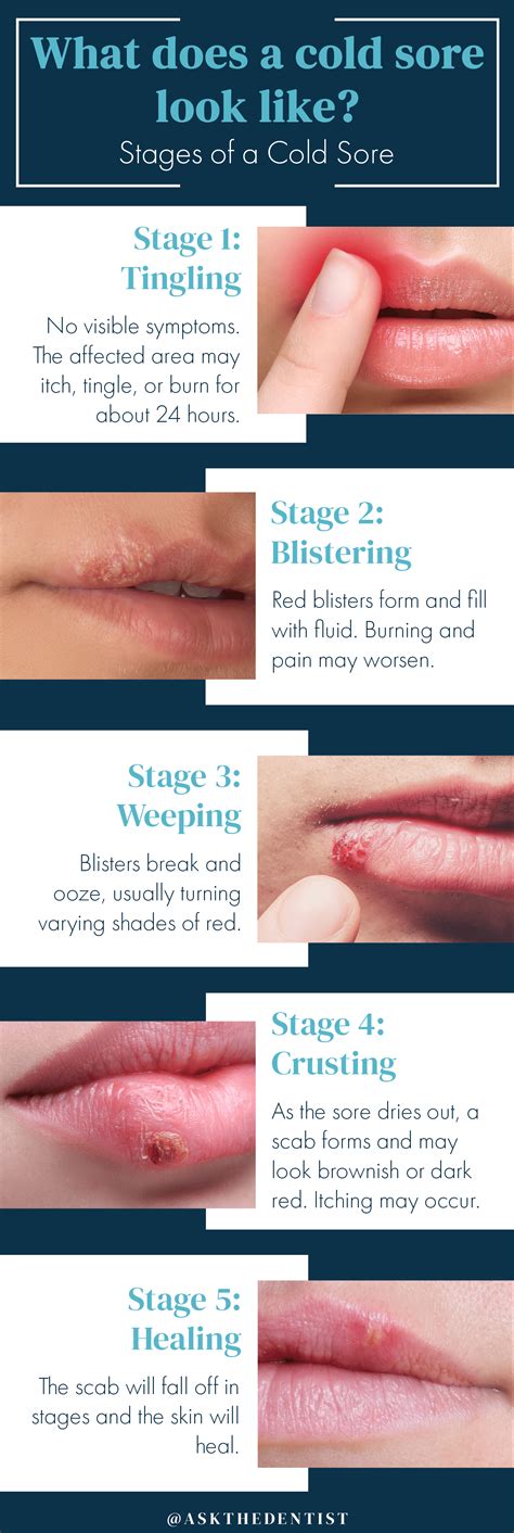 Pictures, Symptoms, Causes, and Treatments of Cold Sores
