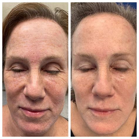 Comprehensive Facial Rejuvenation Before and After - St. Louis ...