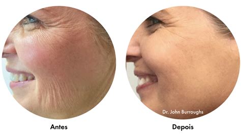 Morpheus Rosto Antes E Depois - Morpheus - Redescubra sua beleza natural
