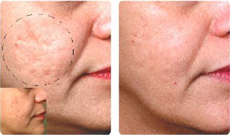 BBL™ Acne Treatment – evole Mediclinic