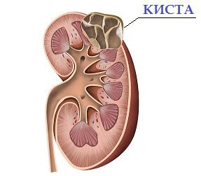 Киста