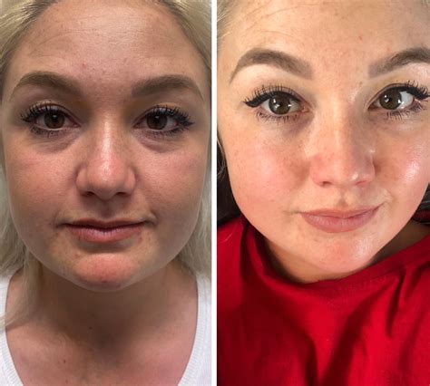 face lift bad 3