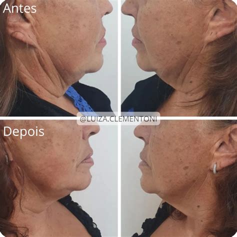 Bioestimulador Nutriex Antes E Depois - Bioestimulador – Dra Luiza Clementoni