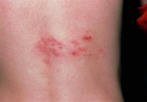 Rash Of Shingles (herpes Zoster) On Lower Back Photograph by Dr P ...