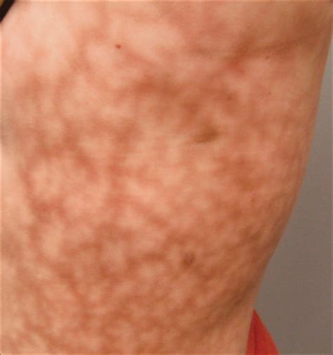 Mild Livedo Reticularis