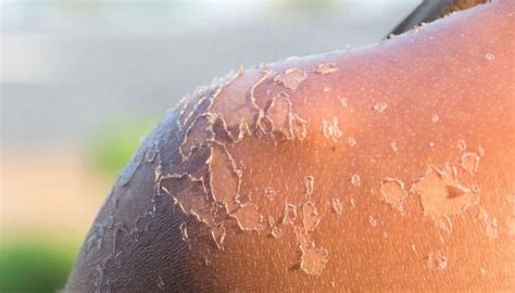 Pessoa Queimada De Sol - Queimadura de sol - Consequências na pele, como evitar e tratamentos