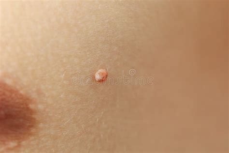 Concept of Body Care with Skin with Papilloma or Mole Stock Photo - Image of birthmark, closeup ...