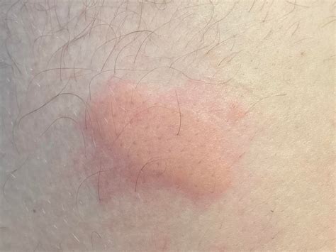 Enbrel sure click today stung bad the entire time it was going in