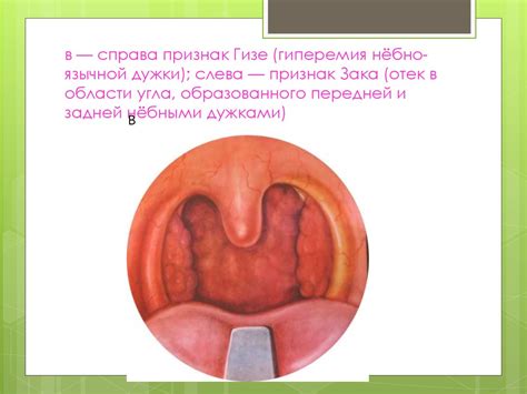Заболевания глотки - презентация онлайн