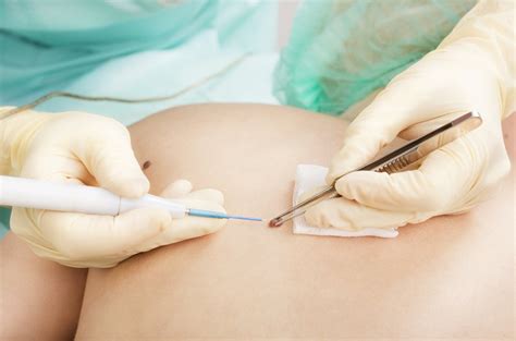 Как избавиться от папиллом на теле? | MedAboutMe