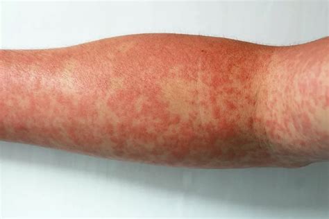 Manchas Vermelhas No Corpo Que Coçam E Se Espalham Dengue - Erupcoes Cutaneas De Dengue Entendendo Os Sintomas Da Dengue: