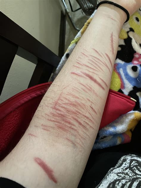 Do anyone else’s scars turn purple when you get cold? : r/SelfHarmScars