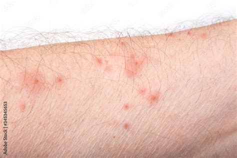 Skin disease rash on a man arm Stock Photo | Adobe Stock