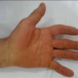 Palmar view of the same hand -Atrophy of thenar muscles with sparing of ...