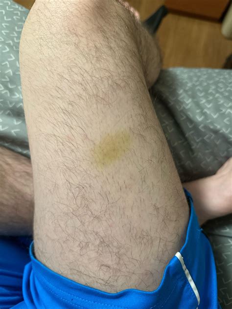 Yellow/Green spot on thigh. Is this a bruise? It doesn’t hurt : r
