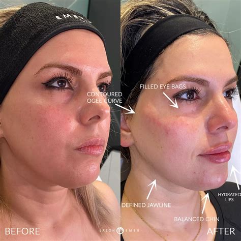 FEMALE FACIAL SCULPTING | Cosmetic Dermatologist Dr. Jason Emer