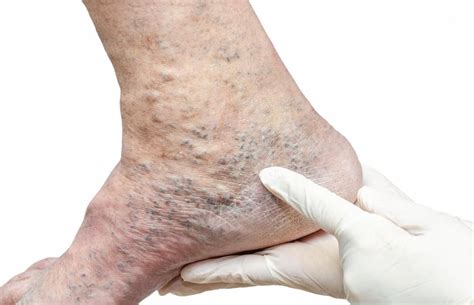 recognizing  signs  vein problems   potential impact