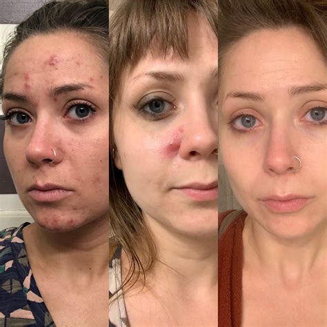 3 months on Accutane and I’m also down about 15 lbs. I have always been