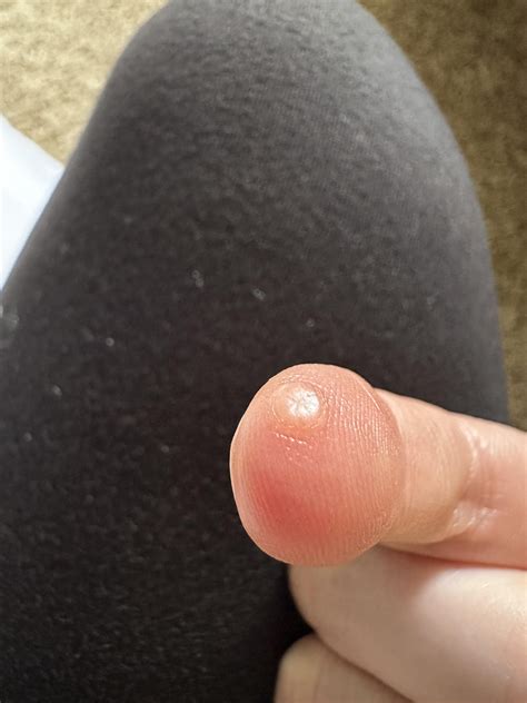 Strange bump on finger tip : r/SkincareAddicts