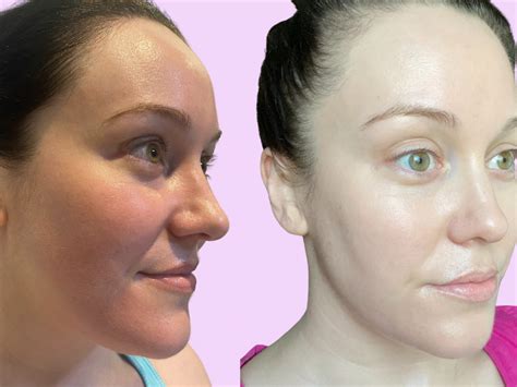 I tried HIFU facial laser to minimise my double chin