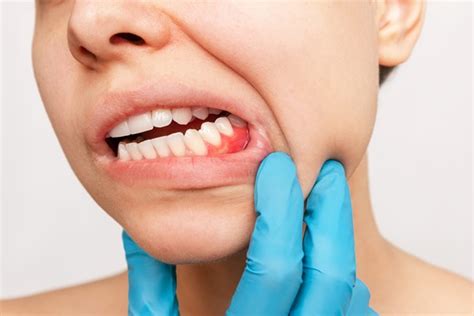 How Does One Get Gum Disease? - Yanase Dental Group Torrance California