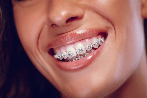 How to Pick the Best Colors for Your Braces