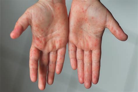 Measles: Causes, Symptoms & Treatment Options