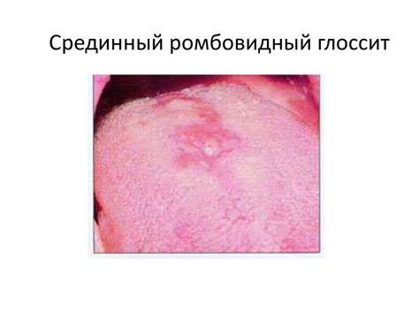 Травма языка вследствие раннего прорезывания зубов - online presentation