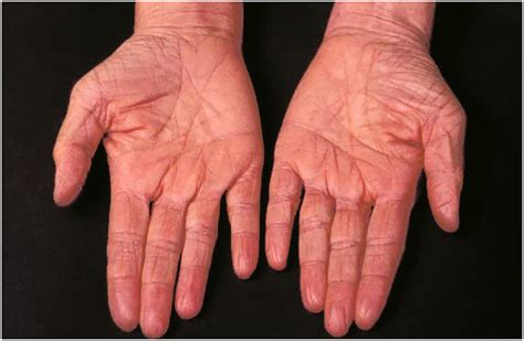 Ichthyosis Vulgaris Histology Free Images At Clker Co - vrogue.co