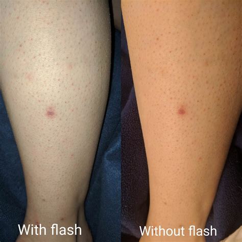 ingrown hair scars 3