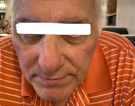 [Routine Help] Dark under eye after cancer treatment, overall