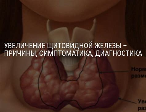 Заболевания щитовидной железы: причины увеличения щитовидки, симптомы ...