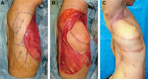 reconstruction    degree rotationally divided latissimus dorsi
