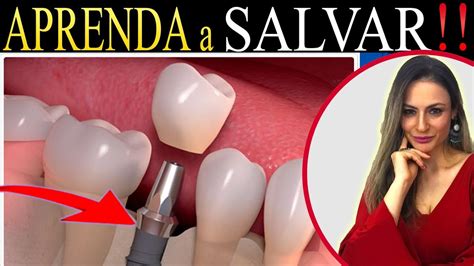 Remédio Caseiro Para Implante Dentário Inflamado - 🟢Peri-implantite (IMPLANTE INFLAMADO) RECEITA CASEIRA, aprenda a tratar ...