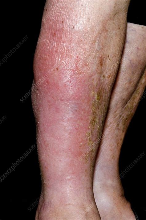 Cellulitis on the leg - Stock Image - C015/5929 - Science Photo Library