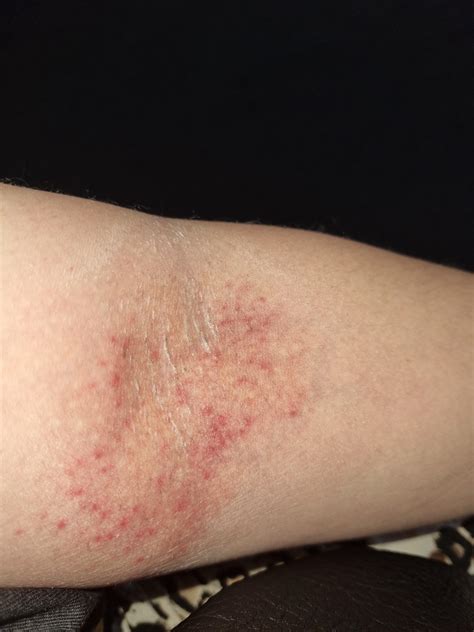 Granular Parakeratosis