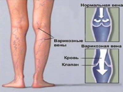 Заболевания вен нижних конечностей