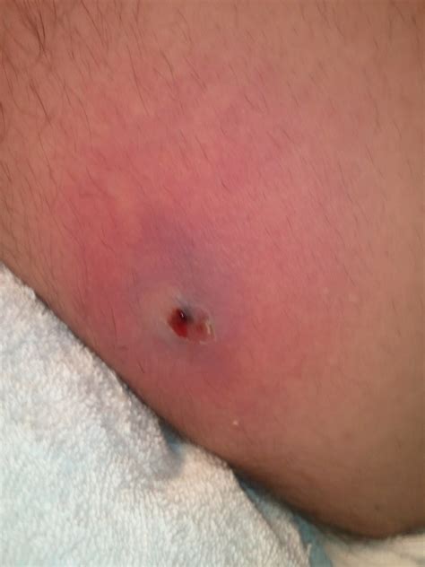 Brown recluse Spider Bite: One week after spider bite.